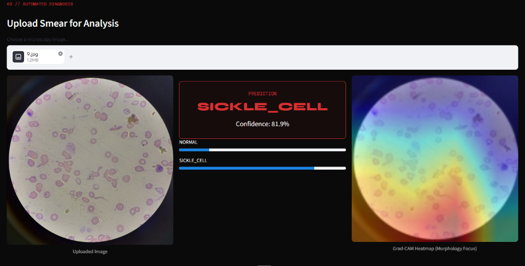 Sickle Cell positive prediction screen